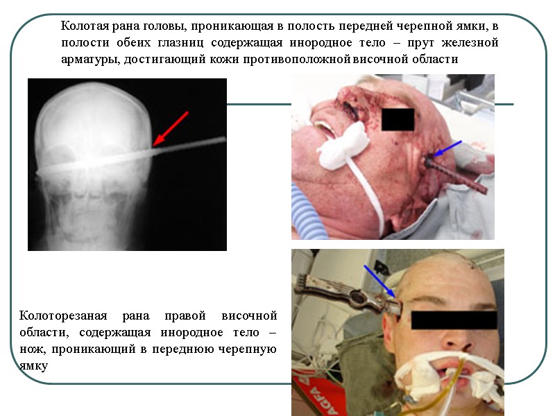 Колотая рана головы, проникающая в полость передней черепной ямки, в полости обеих глазниц содержащая